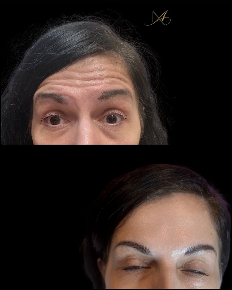 Преди и след ботокс на чело