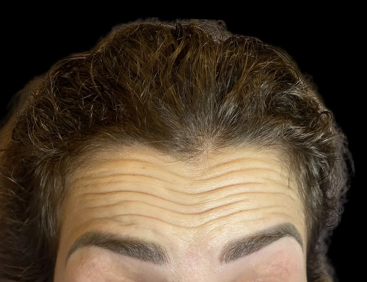 Narim-Adem-25 Преди Botox на челото Dr. Нарин Адем
