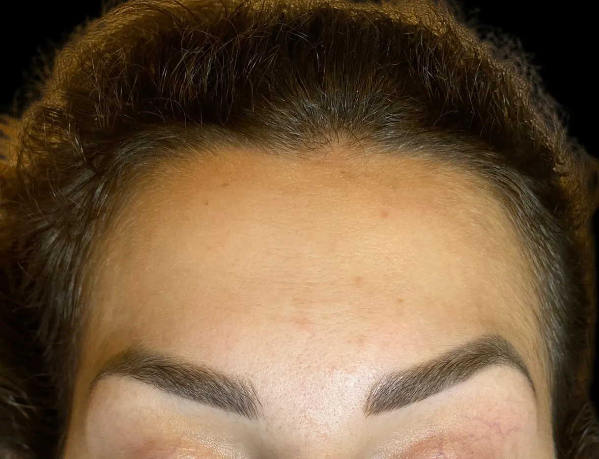Narim-Adem-26 След Botox на челото Dr. Нарин Адем